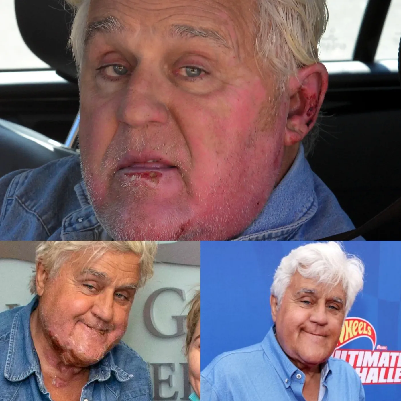 Severe Accident - Jay Leno Hospitalized in Critical Condition